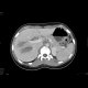 Liver hematoma: CT - Computed tomography